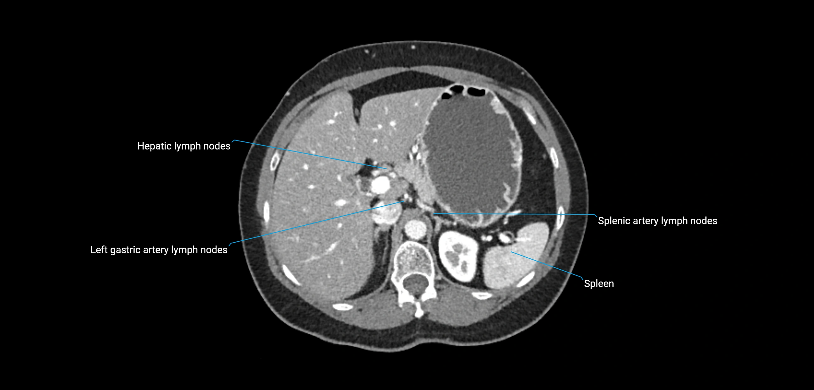CT ct abdominal lymph nodes  axial cross sectional anatomy  enchanced radiology image -img-00002-00133.webp
